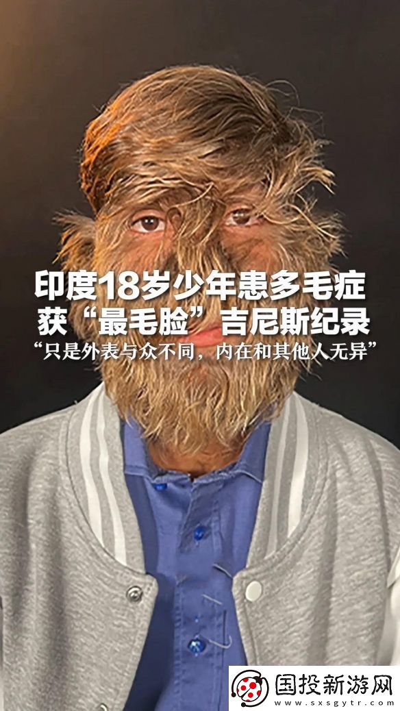 印度少年獲“最毛臉”吉尼斯紀錄